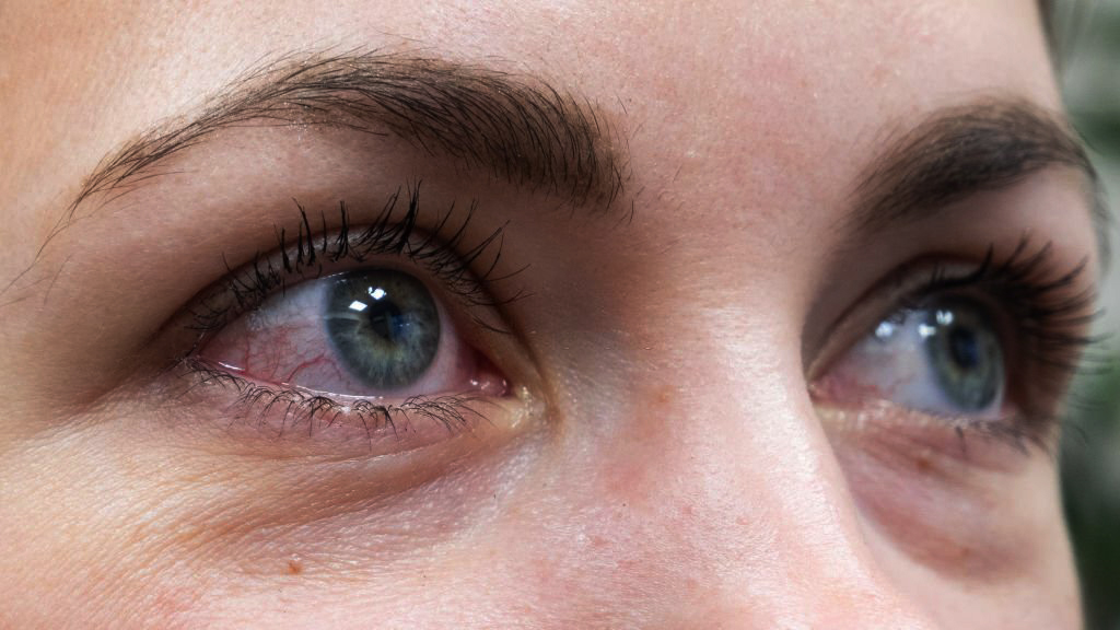 Sante-Education - Article - Yeux rouges : Causes et facteurs de risque ...